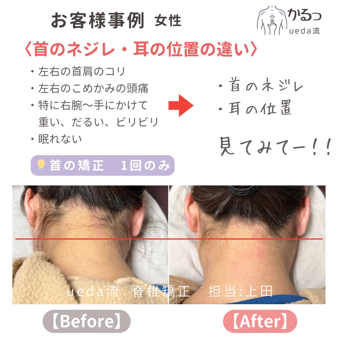 首の捻れ・耳の高さに注目！驚きの変化とは？｜高砂整体｜播州エリア