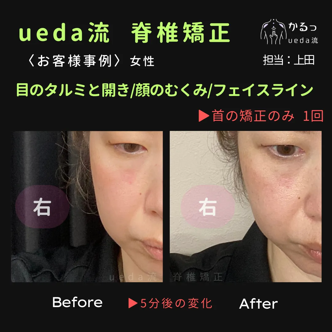 フェイスラインのタルミに注目｜高砂整体｜播州エリア