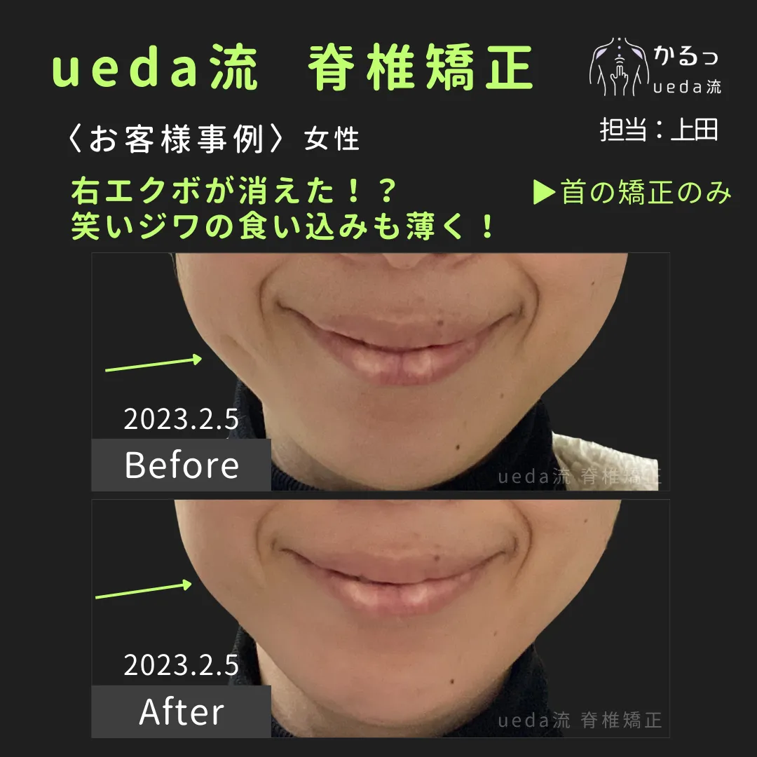 エクボが消えた？！｜高砂市｜整体｜播州エリア