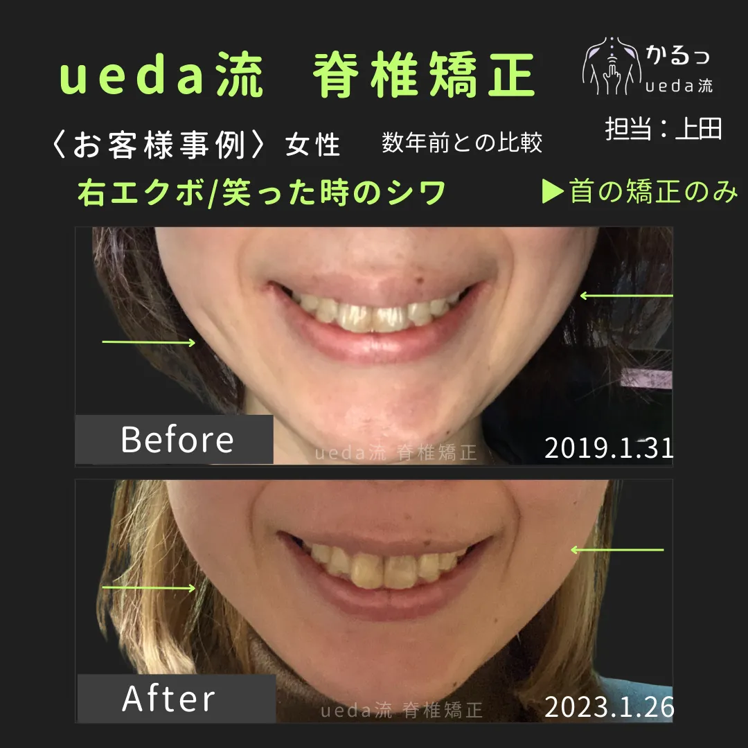 フェイスラインのシワに注目！｜高砂市｜整体｜播州エリア