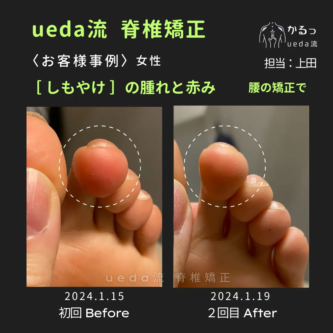 血行不良は 「しもやけ」 にも関係が！？｜整体｜高砂｜播州エリア