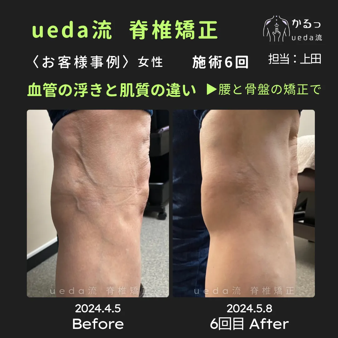［整体］ueda流 脊椎矯正