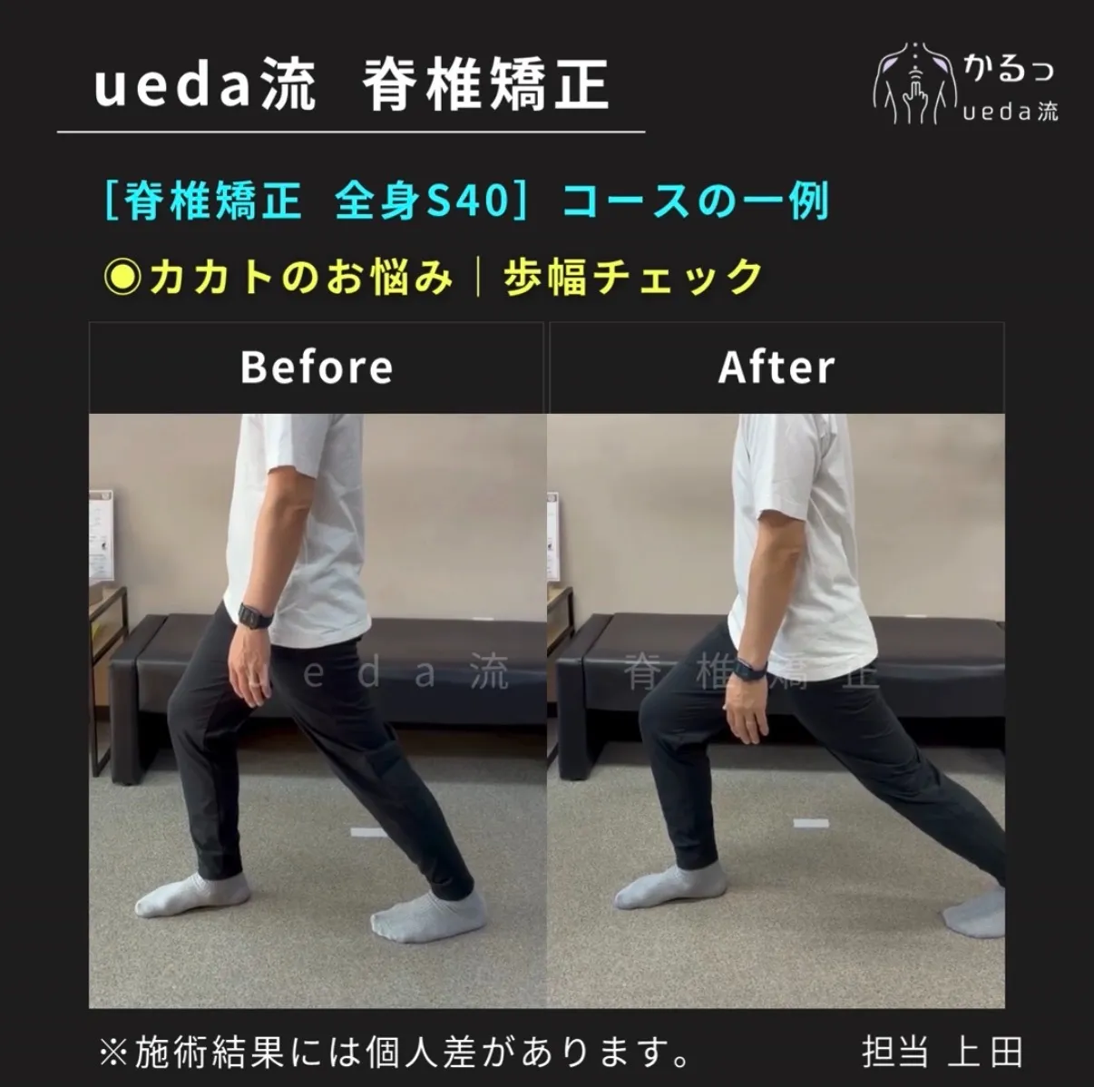 半年続くカカトの痛み・・・腰や歩幅の動きも関係する？｜整体｜高砂・加古川・姫路